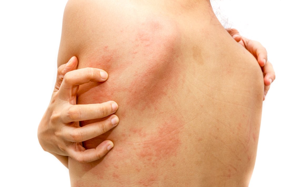 Managing Urticaria: Impact and Prevention of Skin Hives